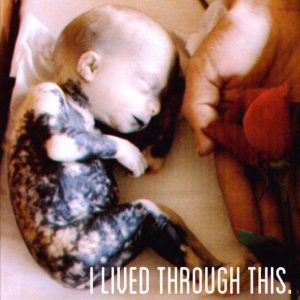 aborted-baby-who-survived